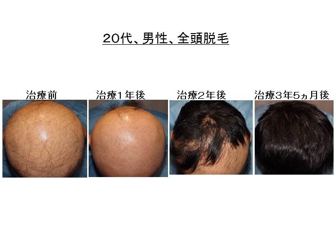 全頭脱毛　名医""